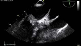 ENORMOUS MITRAL VEGETATION WITH SEVERE MR [upl. by Alyat]