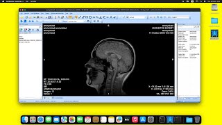 MicroDicom DICOM Viewer on macOS Sequoia using Wine [upl. by Galatia]