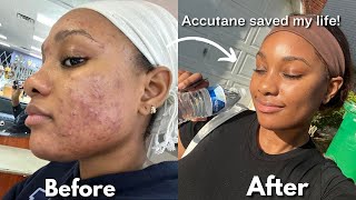 MY 6 MONTH ACCUTANE JOURNEY  side effects purging amp skin care routine  Ice Diallo [upl. by Ahsilef630]