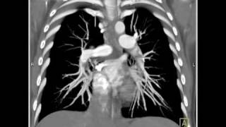 Lung Anatomy Pulmonary Embolism VRT [upl. by Ysnat]