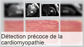 Causes et diagnostic de la sclérose cardiaque diffuse [upl. by O'Doneven]