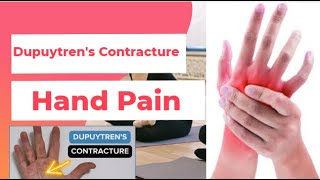 Dupuytrens Contracture  Hand Pain  PhysiotherapyKnowledge [upl. by Mirelle]