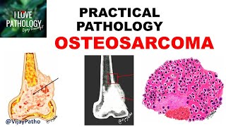 OSTEOSARCOMA Clinical  Radiological features amp Morphology [upl. by Eiznik]