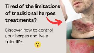 Natural supplements Herpes Relief Solution [upl. by Ykcul498]