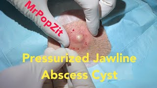 Pressurized Jawline Abscess Cyst Squirting cyst pop with surprising large sac dissection on neck [upl. by Iramo]