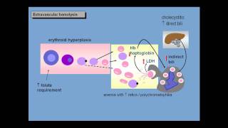 Anemia of increased red cell destruction loss [upl. by Dominus]