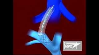 Endoprosthesis  Transjugular Intrahepatic Portosystemic Shunt TIPS [upl. by Grani]