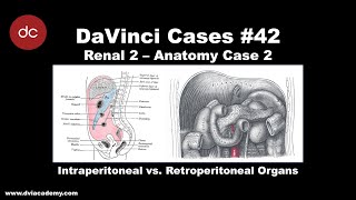 Intraperitoneal vs Retroperitoneal Hemorrhage DaVinciCases Renal 2  Anatomy Case 2 [upl. by Ynnos]