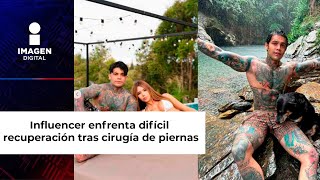 Influencer que se sometió a cirugía de alargamiento de piernas vive tormentosa recuperación [upl. by Ingrim]