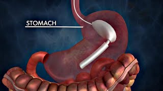 The Possible Dangers of Gastric Balloons for Weight Loss [upl. by Tiras]