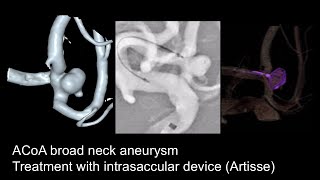 Aneurysm ACoa  Artisse [upl. by Marsiella867]