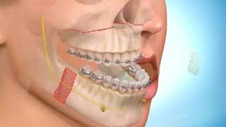 Avancée du maxillaire et recul de la mandibule [upl. by Oyam972]