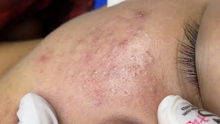 slightly inflamed cheek amp chin blackheads  dermacool 0201 [upl. by Suoilenroc]