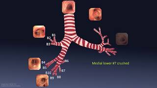 Mastering Bronchoscopy for Thoracic Surgery Chapter 1 [upl. by Natsyrk]