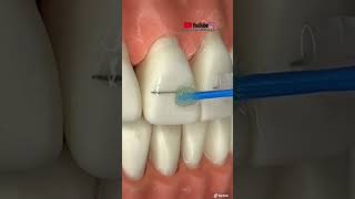 TUTORIAL “Instalación de BRACKETS estéticos” [upl. by Higinbotham]