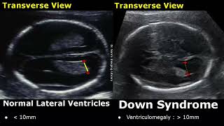 Fetal Ultrasound Normal Vs Down Syndrome  Soft Markers In Fetus For Trisomy 21  Aneuploidies USG [upl. by Gilman]