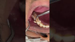 tooth fracture broken toothfyp video foryou tiktok viral tiktok trending love foryou [upl. by Delwin219]