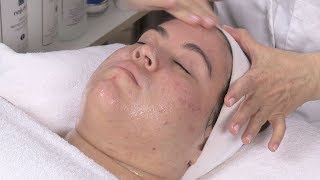 Diet Related Acne And Facial With Alessandra Part 3 [upl. by Tenej]