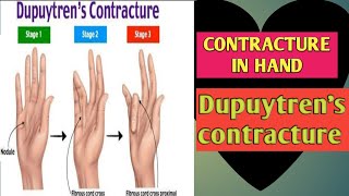 Dupuytrens Contracture in Hindi [upl. by Vonnie]