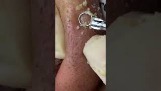 Remove ACNE FAST With These Treatment Secrets dermatologia acne blackheads [upl. by Maynard]