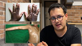 Who Can Use OPZELURA  Segmental VS Non Segmental Vitiligo [upl. by Spiers436]