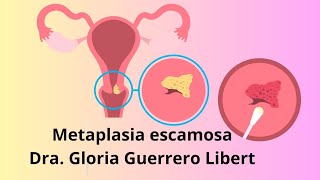 Metaplasia Escamosa en mi papanicolaou ¿Que hacer [upl. by Ailehc824]