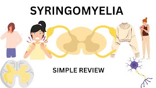 syringomyelia  featurescauses and treatment [upl. by Phillada659]