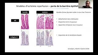Ischémie mésentérique  Simon BOURCIER [upl. by Avigdor]