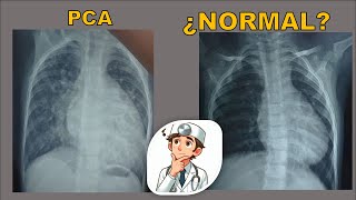 Radiografía en Cardiopatías Congénitas  PCA  Conducto Arterioso [upl. by Ott]