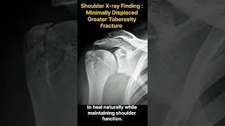 Greater Tuberosity Fracture From Diagnosis to Recovery 대결절 골절 진단에서 회복까지 [upl. by Suoirad]