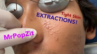 Tight skin acne extractions Comedonal acne with some inflammatory nodules Great session must see [upl. by Aynodal]