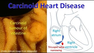 Carcinoid Heart Disease [upl. by Gibert]