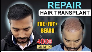 REPAIR Hair Transplant Results at Medispa Hair Transplant India  Best Cost  Best Result [upl. by Hamner]