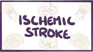 Ischemic Stroke  causes symptoms diagnosis treatment pathology [upl. by Entwistle]