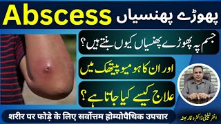 Abscess پھوڑے پھنسیاں फोड़ा Homeopathic Treatment By Dr Waqar Bhutta In Urdu Hindi [upl. by Aushoj231]