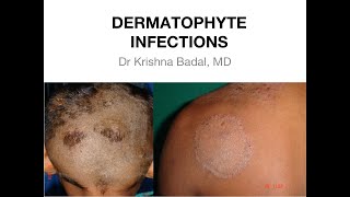 Dermatophyte infections of Skin [upl. by Ahsinrad42]