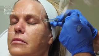 Temple Filler Injections [upl. by Duer]