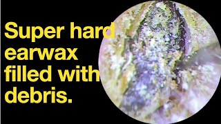 Super hard earwax filled with debris ear wax removal  ear cleaning  ASMR  relaxation  relax [upl. by Monteria]