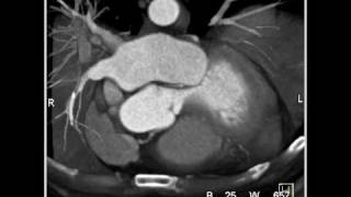 Cardiac Coronary anatomy 1 of 3 [upl. by Enileme]