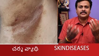 HOW TO SOLVE ERYTHRASMA SKIN DISEASES IN TELUGU CORYNEBACTERIUMHOMEOPATHIC TREATMENT WAKEUP [upl. by Alaham33]