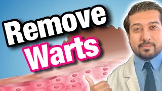 Wart Removal 101  How to Get Rid of Warts [upl. by Sivart]