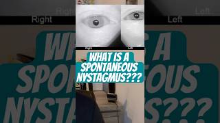 Spontaneous nystagmus  IS this causing YOUR Dizziness vestibular [upl. by Seftton]