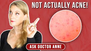 Fungal Acne Treatment and Prevention Tips for Clear Skin  Doctor Anne [upl. by Adlig]