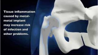 Johnson amp Johnson Hip Implant Recall Explained by Orthopedic Surgeon [upl. by Maurita]