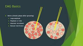 Neuropathy vs myopathy on EMG [upl. by Ahsinod]