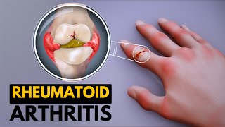 Rheumatoid Arthritis Causes Signs and Symptoms Diagnosis and Treatment [upl. by Nwahsat]