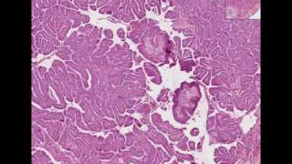 Histopathology Thyroid Papillary carcinoma [upl. by Nhguaved870]