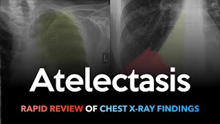 Atelectasis Rapid Review of Chest Xrays [upl. by Milurd43]