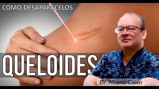 Cómo DESAPARECER las DESAGRADABLES CICATRICES QUELOIDES 🙂 Dr ALBERTO CALVO QUIROZ [upl. by Adianes946]