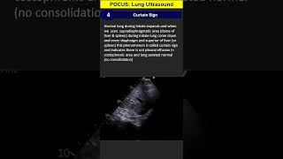 POCUS 4 Lung Ultrasound Curtain Sign [upl. by Morita]